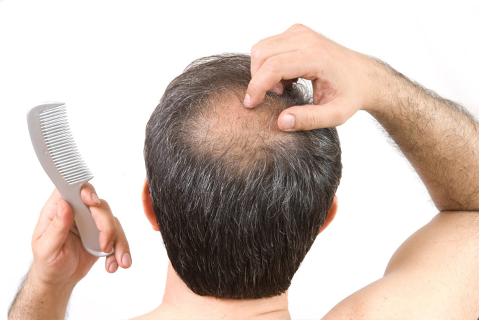 La mitad los hombres mayores de 50 años alopecia androgenética – Salud y Medicina