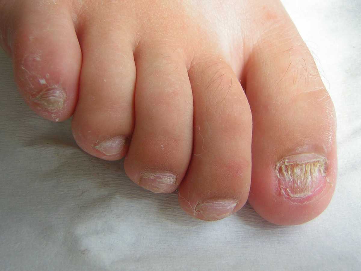 Hongos en las uñas tratamientos síntomas e información en CuídatePlus