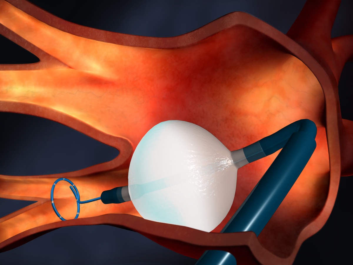 Криобаллонная абляция легочных вен. Криоабляция фиброаденомы молочной железы. Криоабляция сердца. Криобаллонная изоляция устьев легочных вен. Катетерная абляция сердца что это такое.