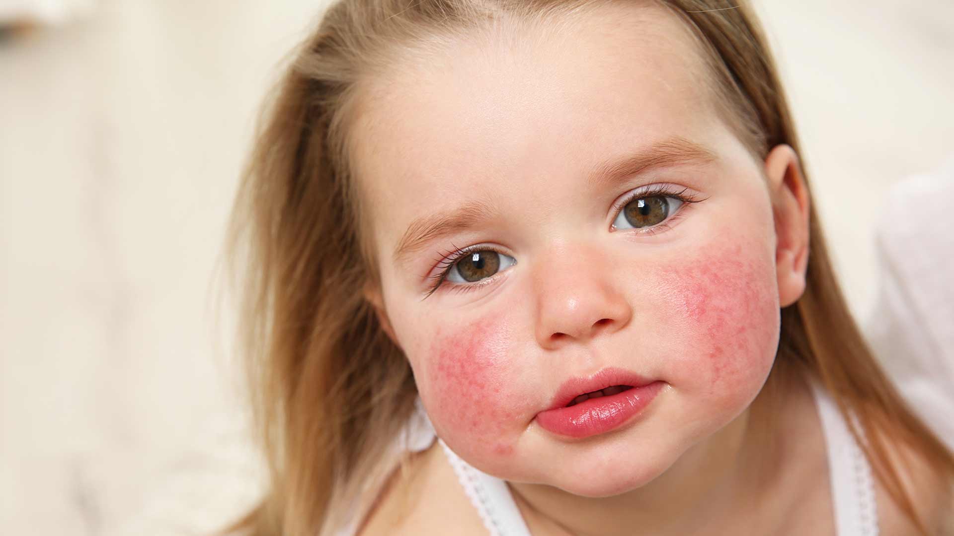 Jusqu’à 20% des enfants espagnols souffrent de dermatite atopique – Santé et Médecine